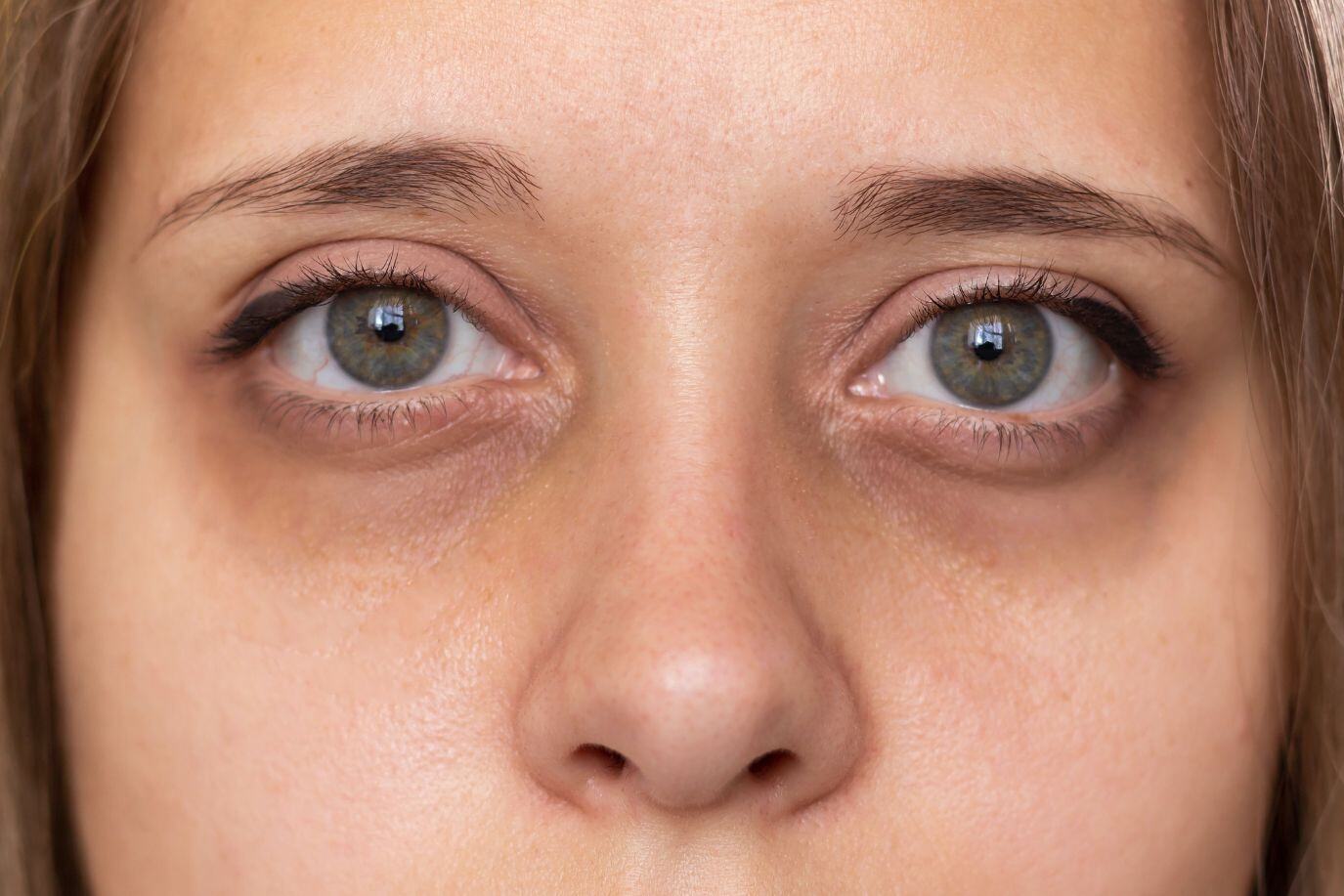 Dark Circles Under Eyes, How to Spot an Alcoholic Face? By Avenues Recovery