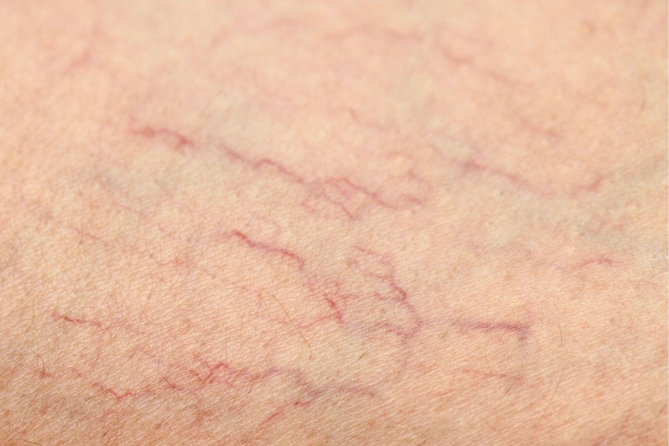 Spider Veins, How to Spot an Alcoholic Face? By Avenues Recovery