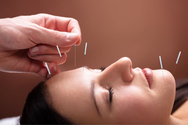 Acupuncture is used in holistic rehab at Avenues Recovery