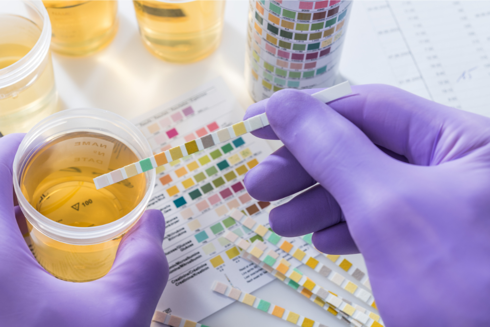 Avenues Recovery explores how urine samples are used to test for drugs in your system